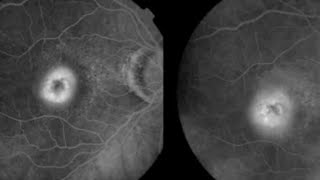 FFA CLASSIFICATION OF CNVM (Choroidal neovascular membrane) | Occult v/s Classic CNVM