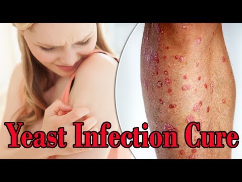 How To Kill Vaginal Yeast Infection Naturally At Home | Yeast Infection Cure How To Kill Vaginal Yeast Infection Naturally At Home | Yeast Infection Cure