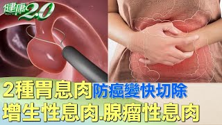 2種胃息肉防癌變快切除 增生性息肉.腺瘤性息肉 健康2.0  @tvbshealth20