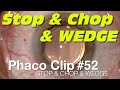 Phaco Clip #52 - Stop & Chop & WEDGE