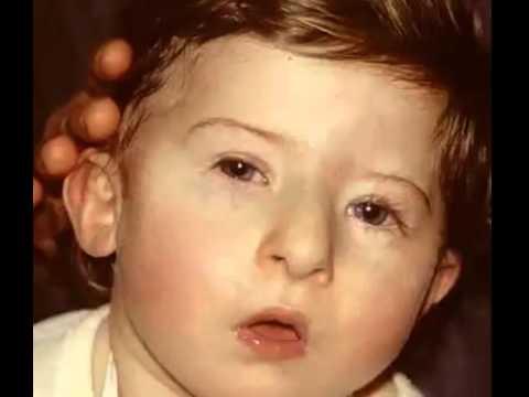 DiGeorge Syndrome - YouTube