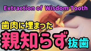 親知らず抜歯【歯肉に埋まった親知らず】 Extraction of Wisdom Tooth