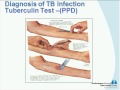 tuberculosis and hiv