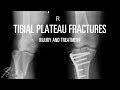 Tibial plateau fracture: Mechanism of injury and treatment options