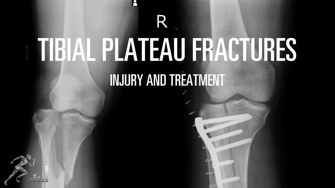 Tibial Plateau Fracture: Mechanism Of Injury And Treatment Options ...