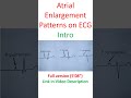 Atrial Enlargement Patterns on ECG