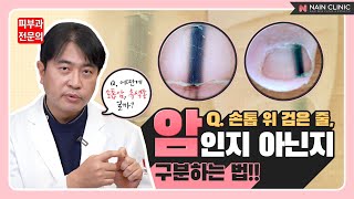 손톱 위에 검은줄, 이게 암일 수도 있다고?? 암 구별하는 법!! | 흑색종 구별하는 법!