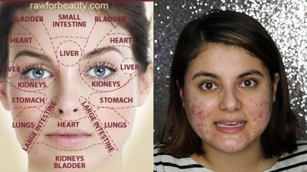 FACE MAPPING FOR ACNE - Face Map With Me! - YouTube