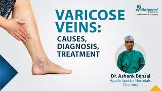 Varicose Veins : Causes, diagnosis, treatment | Dr. Ashank Bansal | Health Expert