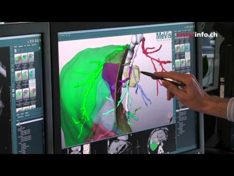 New hope for liver cancer patients New hope for liver cancer patients