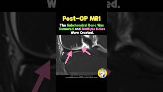 (Fig 5-C.01) MRI Findings of hUCB-MSCs Implantation