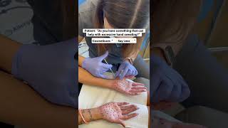 Botox for your hands?? #shorts #botox #sweat