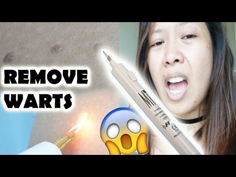 WORLD'S MOST AMAZING PEN! SKIN TAG (WART) REMOVAL | The Glam Owl WORLD'S MOST AMAZING PEN! SKIN TAG (WART) REMOVAL | The Glam Owl