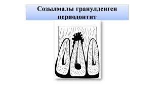 Созылмалы периодонтиттің этиопатогенезі.