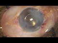 how to go about phaco in a case with severe corneal opacities