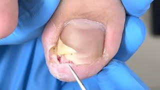 Solve incarnate nail problems and quickly heal 【xue yidao】 #ingrown