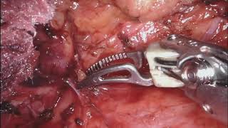 Asvide: Video demonstration of a robotic thymectomy with left side approach for a stage II thymoma