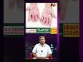 సోరియాసిస్ ఎందుకు వస్తుంది అంటే.. rk psoriasis u0026 ayurvedic center ntv