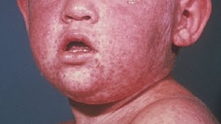 Reality Check: Measles In Minnesota