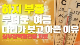 왜 여름이 되면 부종이 심해질까요? 불청객 심부정맥혈전증까지? (KCS 부산 수흉부외과 김병균 원장)