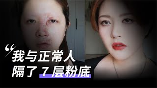 滿臉疤痕的我，做了美妝 UP 主【親歷者說】