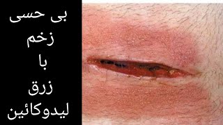 روش بی حسی موضعی زخم از طریق تزریق لیدوکایین/lidocain injection