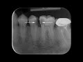 root canal treatment of the mandibular second premolar and first molar tooth in a single sitting.