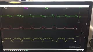 Revers trigger and esophageal pressure