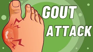 Gout triggers : 7 MAIN conditions that trigger GOUT ATTACKS !