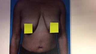 Breast Lift without Implants- Detroit, Michigan - Dr. Anthony Youn