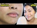 How I Cleared My Skin in 2 months *4 steps that changed my life* | My new skincare routine