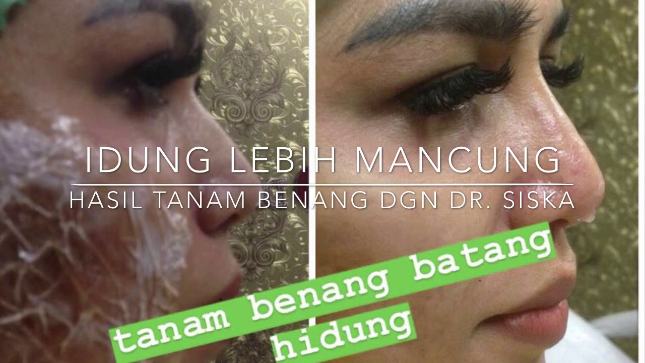 Proses Tanam Benang Hidung Gebby Vesta Oleh Dr. Siska Khairunnisa - YouTube