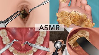 ASMR Collection 2| Remove Large Plantar Warts, Huge Navel Stone, Salivary Gland Stones, Ear Cleaning