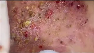 Popping huge blackheads and Pimple Popping - Best Pimple Popping Videos #65