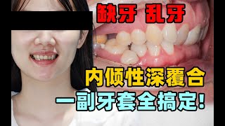 内倾性深覆合！缺牙！乱牙！一副牙套统统搞定！一下还省了几个w的种牙钱！