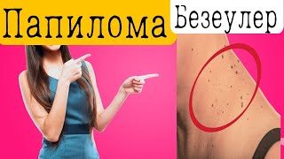 Папиллома деген не? Оны қалай емдеу керек?