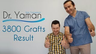 Dr Resul Yaman Hair Clinic - 3800 Grafts 12 Months Result