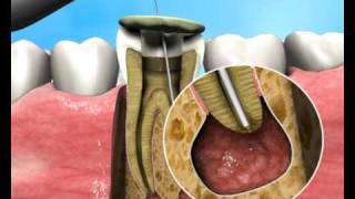 Treatment of Apical Periodontitis - a new approach