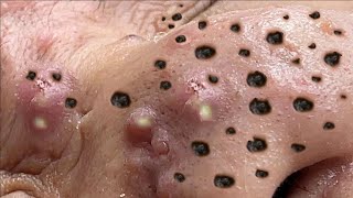 Big Pimples | Acne Treament Under The Skin #01 | Relax Every Day With Thuy Truong Sac Dep Spa | Acne