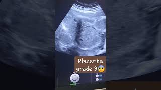 33w/ placenta grade 3 (pathologic)