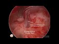 Endoscopic underwater fistula repair of lateral semicircular canal