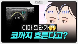 이마 필러가 왜 거기서 나와😵‍💫? 이마 필러 부작용🙄?! 과주입·울퉁불퉁·지방이식 후 필러 시술 [초이성형외과]