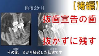 抜くと言われた歯を残す【後編】顕微鏡を使った根管治療内容　Endodontics | Root Canal Treatment