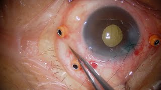 Suprachoroidal Fluid Drainage