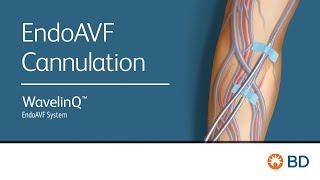 BD 35094 WavelinQ Cannulation Motion Graphic EMEA