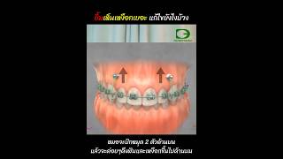 ยิ้มเห็นเหงือกเยอะ คืออะไร❓ จัดฟันช่วยแก้ไขได้มั้ย❓ #หมอนลจะเล่าให้ฟังครับ