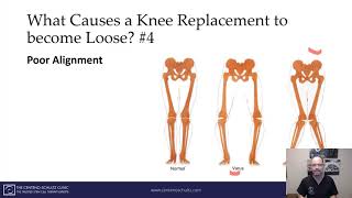 7 Most Common Symptoms of Loose Knee Replacement