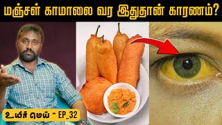 Causes of Gall bladder stone | பித்தப்பை பிரச்சனைய அலட்சியப்படுத்தாதீங்க! | Uyirmei Ep-32