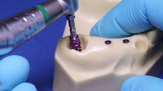 Straumann® BLX Implant System - Extracted Molar