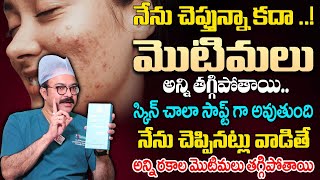 మొటిమలు అన్ని తగ్గిపోతాయి..స్కిన్ చాలా సాఫ్ట్ గా అవుతుంది |Anti  Acne Face wash For Pimple Free Skin